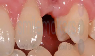 A closeup of a mouth with 4 teeth showing and one missing in the middle