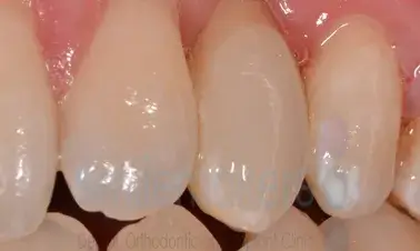 A closeup of a mouth with 4 teeth showing