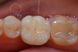 BackTeeth 3 After Compressed 300x200 2
