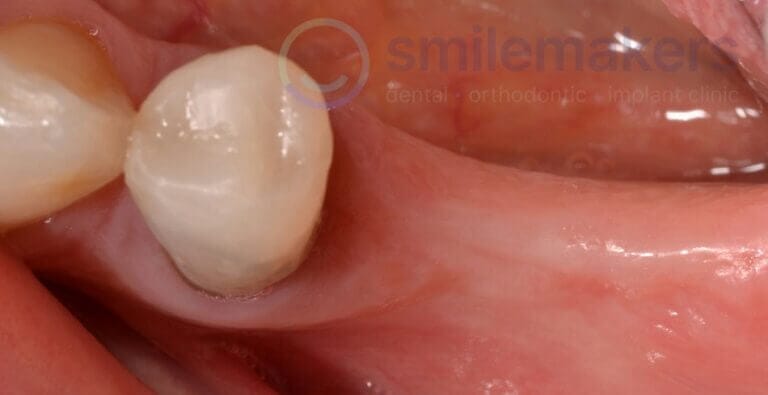 BackTeeth 4 Before Compressed 768x395 2