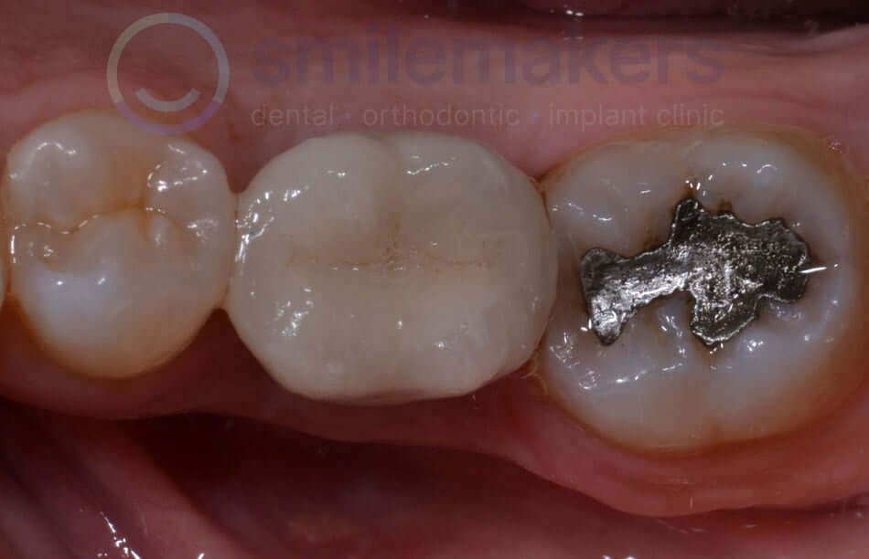 BackTeeth 5 After Compressed 1