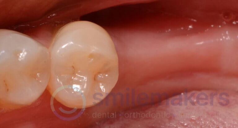 BackTeeth 6 Before Compressed 768x415 2