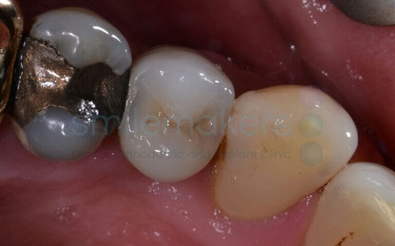 BackTeeth 8 After Compressed 768x479 2