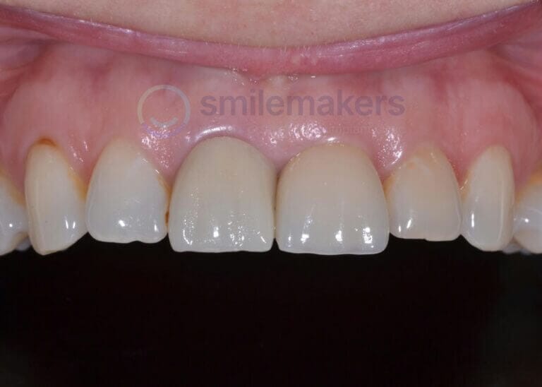 FrontTeeth 1 After Compressed 768x548 2