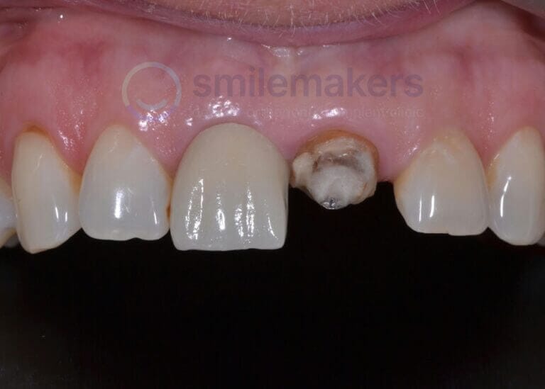 FrontTeeth 1 Before Compressed 768x549 2