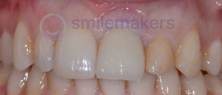 FrontTeeth 11 After Compressed 768x328 2