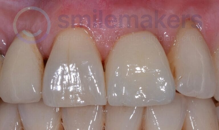 FrontTeeth 12 After Compressed 768x458 2