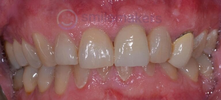 FrontTeeth 13 After Compressed 768x350 2