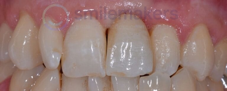 FrontTeeth 8 After Compressed 768x309 2