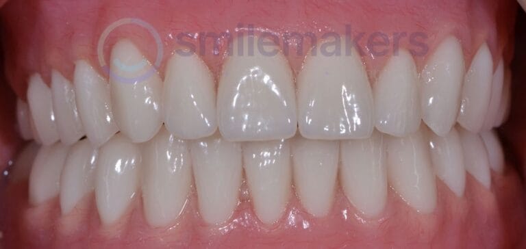 Overdentures 1 After Compressed 768x364 2