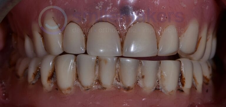 Overdentures 1 Before Compressed 768x363 2