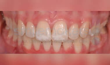 aftr3 5
