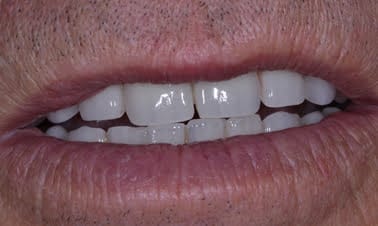 aftr5 3