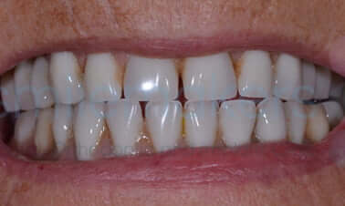 aftr6 3