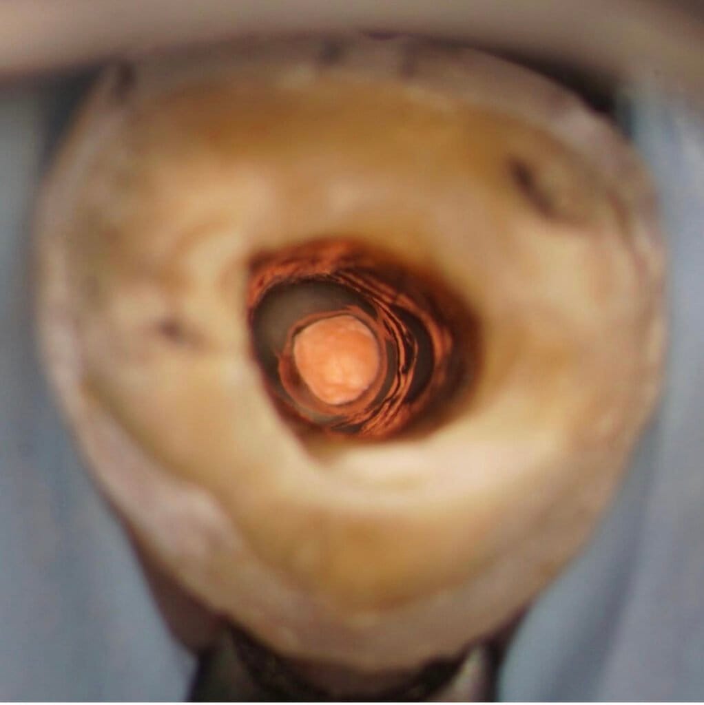 close up of root canal in decaying tooth